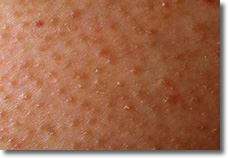 Steroids eczema face